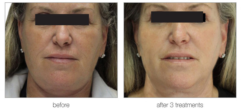 Radio Frequency Face Treatment | Beauty Salon Barkingside gallery image 1